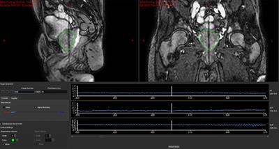 Simulating an intra-fraction adaptive workflow to enable PTV margin reduction in MRIgART volumetric modulated arc therapy for prostate SBRT